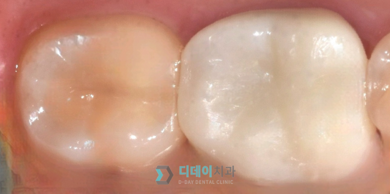 서초 치과, 충치 치료의 핵심은? 관련 이미지 3