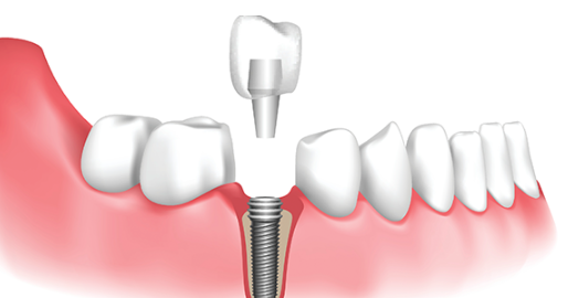 신논현역임플란트, 수술 경험 많은 의사가 알려주는 2가지 기준 관련 이미지 7