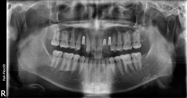 네비게이션임플란트가격, 일반 임플란트보다 비싼 이유? 관련 이미지 7