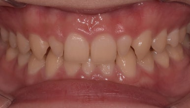 왜소치(작은치아)라미네이트? 치아 모양과 크기, 바꿀 수 있습니다. 관련 이미지 3