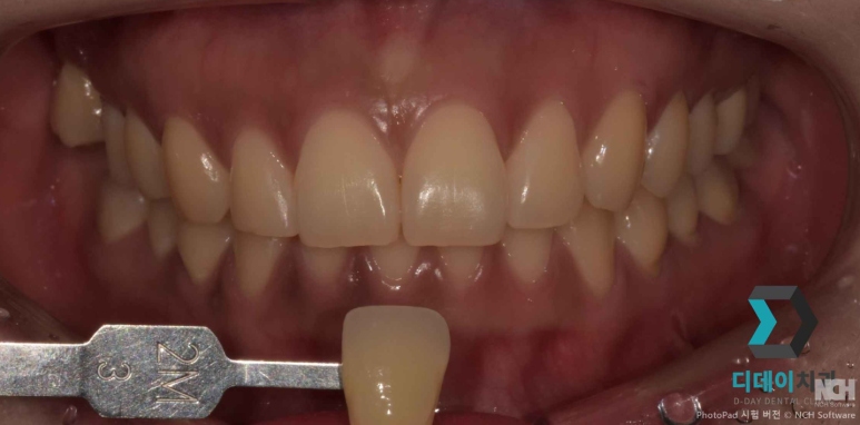 치아미백 라미네이트 잘하는 곳 찾는 2가지 기준 관련 이미지 4