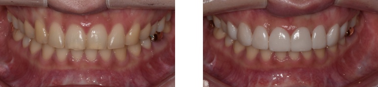 무삭제라미네이트, 아무나 못 하는 이유 관련 이미지 1