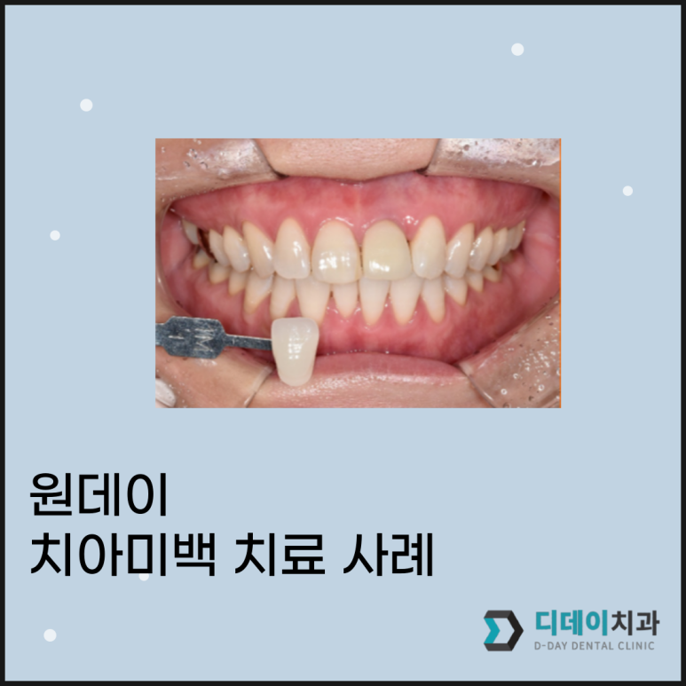 선릉역/신논현 치아미백? 치과의사가 설명드립니다. 관련 이미지 1