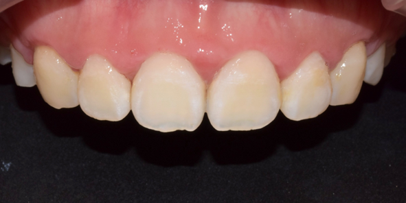 잇몸절제? 절개없이 레이저로 잇몸성형한 후기 관련 이미지 7