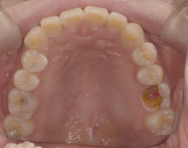 젊은나이임플란트? 젊을수록 더 빨리 심어야합니다. 관련 이미지 5