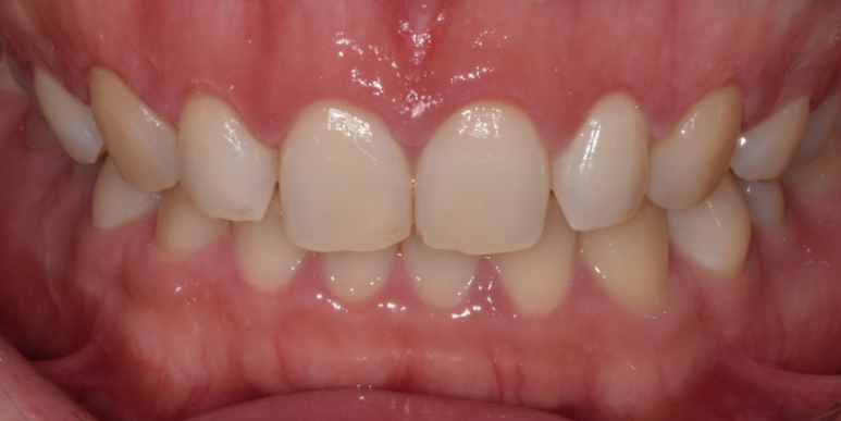 잇몸성형가격? 비용, 주의사항, 치료 후기 공개 관련 이미지 10