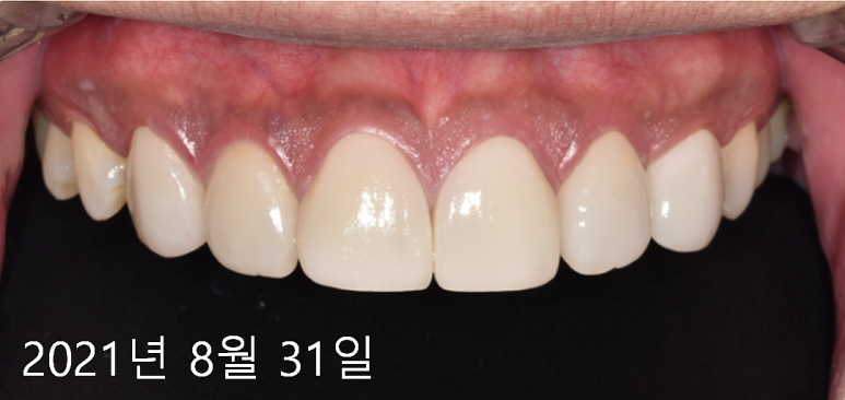 라미네이트 주의사항? 잘못 시술되면 이런 부작용 옵니다... 관련 이미지 5