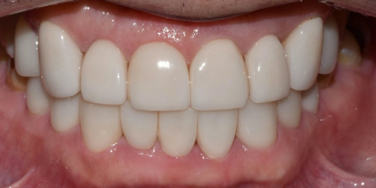 라미네이트 전후 비교, 주의사항, 비용까지 총정리 관련 이미지 8