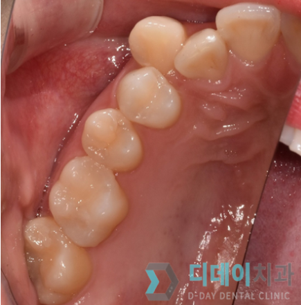 왼쪽어금니통증, 방치하면 안 되는 이유 3가지 관련 이미지 4