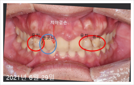 디지털임플란트 가격? 관련 이미지 1