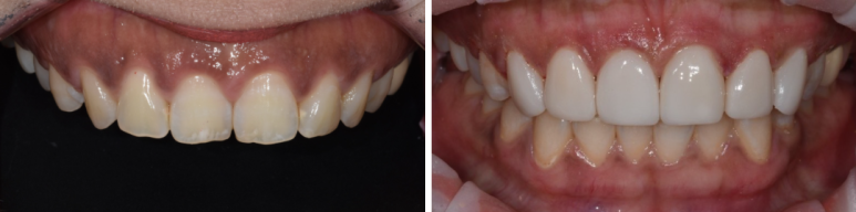 최소삭제라미네이트, 비용부터 치과 고르는 방법 관련 이미지 7