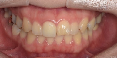 라미네이트 전후사진과 치료비용까지 숨김없이 알려드립니다. 관련 이미지 6