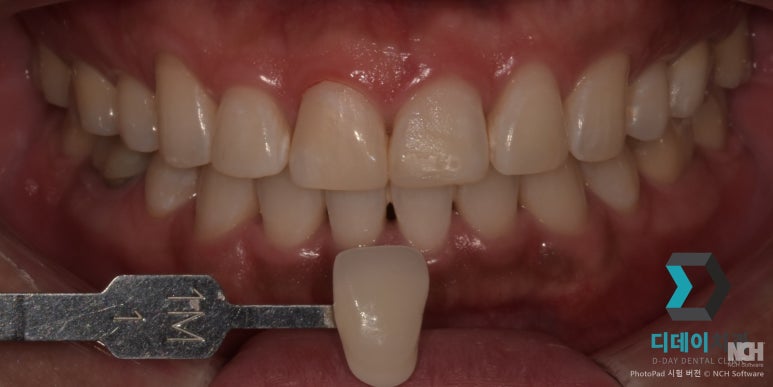 선릉역치아미백후기 보기 전에 관련 이미지 8