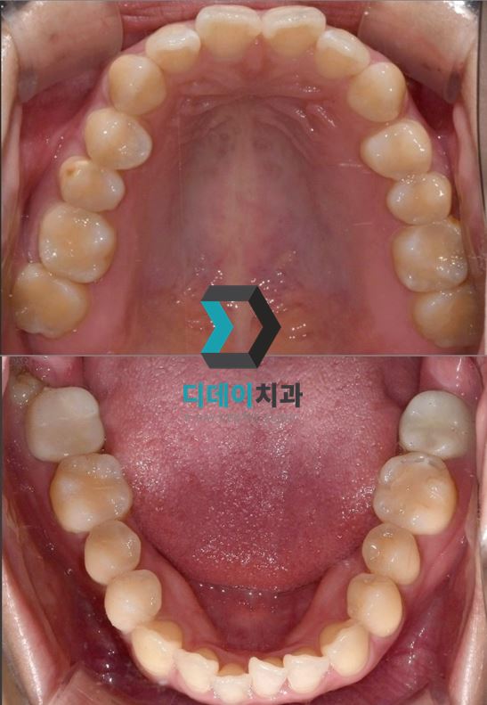 크라운수명, 10년 넘게 쓰고도 교체 안 할 수 있다? 관련 이미지 6