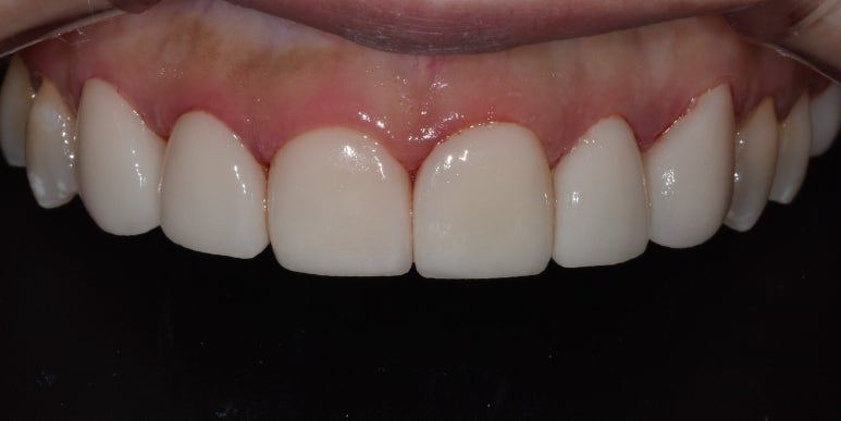 반상치(치아반점)라미네이트, 치료 사례와 비용까지 전격공개 관련 이미지 3