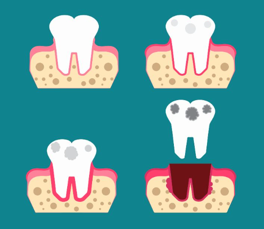 40대 전체 임플란트, 아직 젊은데 치아를 전부 발치해야만 하는 걸까? 관련 이미지 4