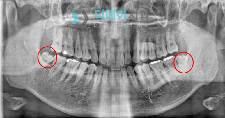 강남사랑니발치? 치과의사가 말씀드립니다. 관련 이미지 2