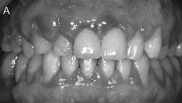 잇몸성형후기, 광고에 속지 않는 방법 관련 이미지 4