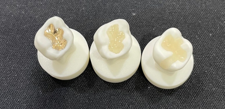 세라믹인레이장점과 단점 솔직하게 말씀드립니다 관련 이미지 4