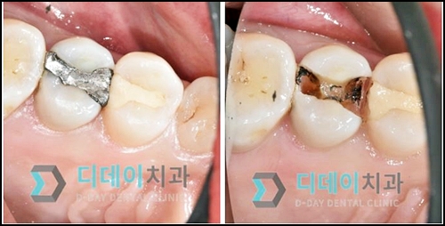 충치치료아픈가요? 치과의사가 알려드릴게요. 관련 이미지 3