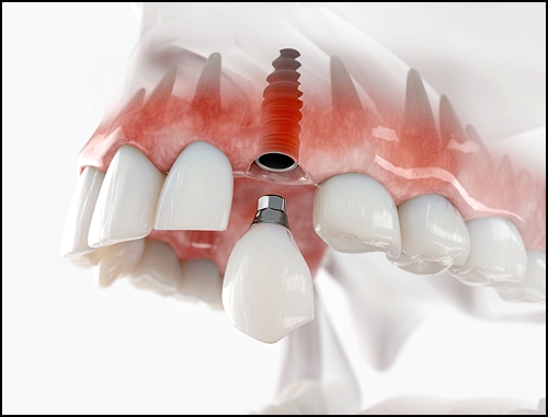 앞니브릿지가격? 치과의사가 말하는 포인트 1가지 관련 이미지 3
