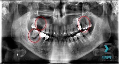 역삼동 임플란트 뼈이식 필요성부터 통증까지, 이 글 하나만 보시면 됩니다. 관련 이미지 3