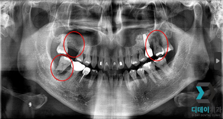 기저질환 환자, 임플란트 가능할까요? 관련 이미지 2
