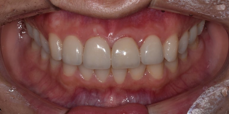 치아반점(반상치, 반점치) 혹시 문제있는건 아닌지 걱정된다면? 관련 이미지 7