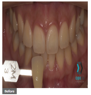 치아미백 vs 라미네이트, 누렁니 탈출하고 싶으신 분들만 관련 이미지 4