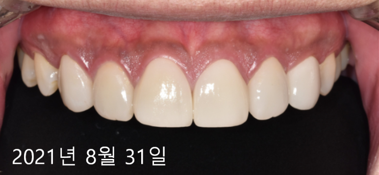 라미네이트떨어짐, 깨짐의 진짜 원인은 따로 있다? 관련 이미지 3