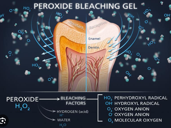 치아미백 vs 라미네이트, 누렁니 탈출하고 싶으신 분들만 관련 이미지 3