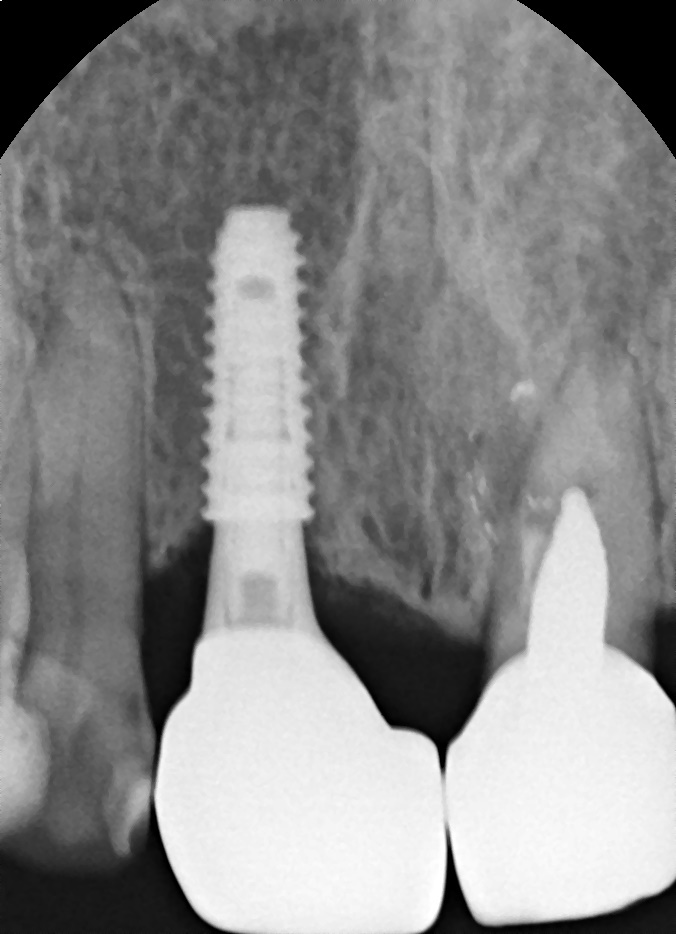 임플란트깨짐, 단순한 문제가 아닐 수 있습니다. 관련 이미지 7