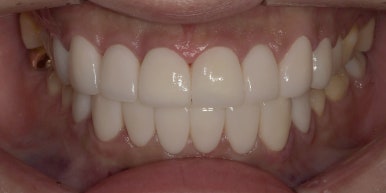 라미네이트 전후사진과 치료비용까지 숨김없이 알려드립니다. 관련 이미지 17