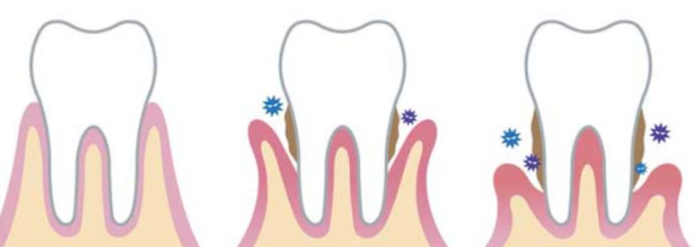 테헤란로 스케일링 치과, 아픈게 무섭다면 필독! 관련 이미지 2
