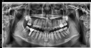 젊은나이임플란트? 젊을수록 더 빨리 심어야합니다. 관련 이미지 9