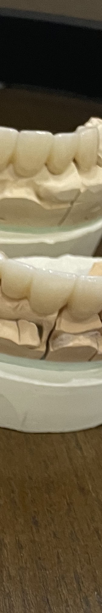 매봉역 치과, 자연치아 잃고 싶지 않다면? 관련 이미지 14