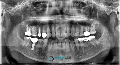 역삼동 임플란트 뼈이식 필요성부터 통증까지, 이 글 하나만 보시면 됩니다. 관련 이미지 2