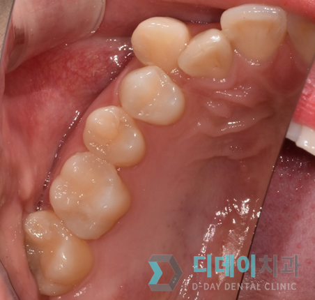 충치치료기간, 치료별 내원횟수와 기간까지 총정리 관련 이미지 5