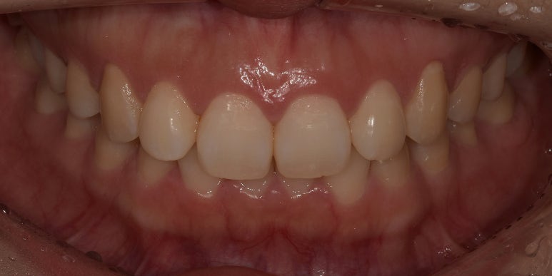 잇몸성형, OO해서 후회해요&hellip; 후회하는 이유는? 관련 이미지 12