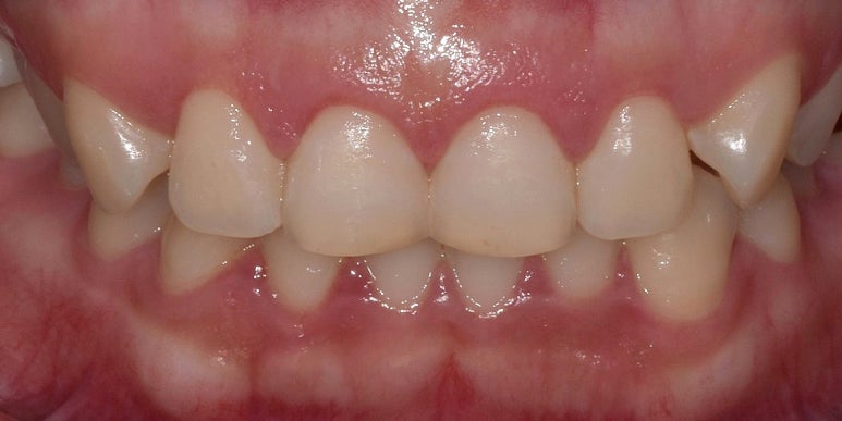 웃을 때 잇몸이 많이 보인다면, 몰라서 못하는 이것 관련 이미지 10