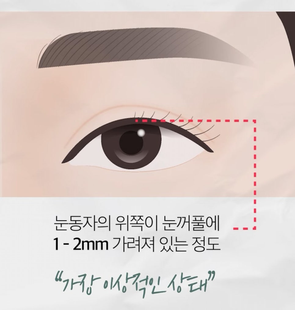 [Eton TV] What a Plastic Surgery Specialist Says Determines the Sparkle in the Eyes image 3