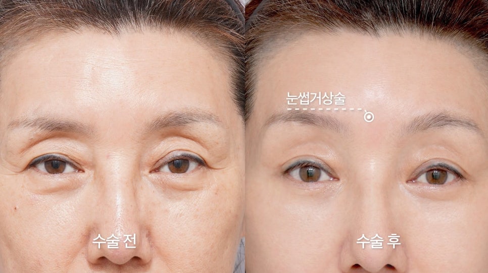 [Aeton TV] Regaining a Mother’s Confidence Through a Facelift: Anti-Aging Surgery Review image 6