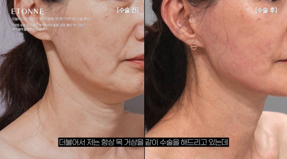 [에톤TV] 10년 젊어지는 기적, 안면거상술로 되찾는 청춘 (턱선, 팔자주름을 개선한 60대 여성 케이스) 관련 이미지 6