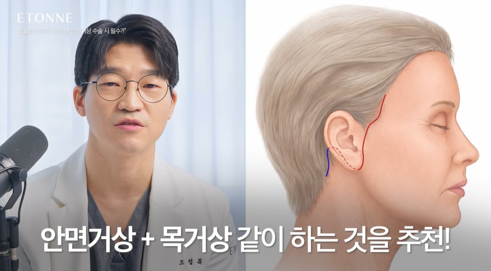 [에톤TV] 안면거상 수술 시, 목거상은 필수일까요?! 관련 이미지 5