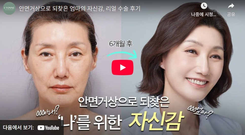 [Aeton TV] Regaining a Mother’s Confidence Through a Facelift: Anti-Aging Surgery Review image 1