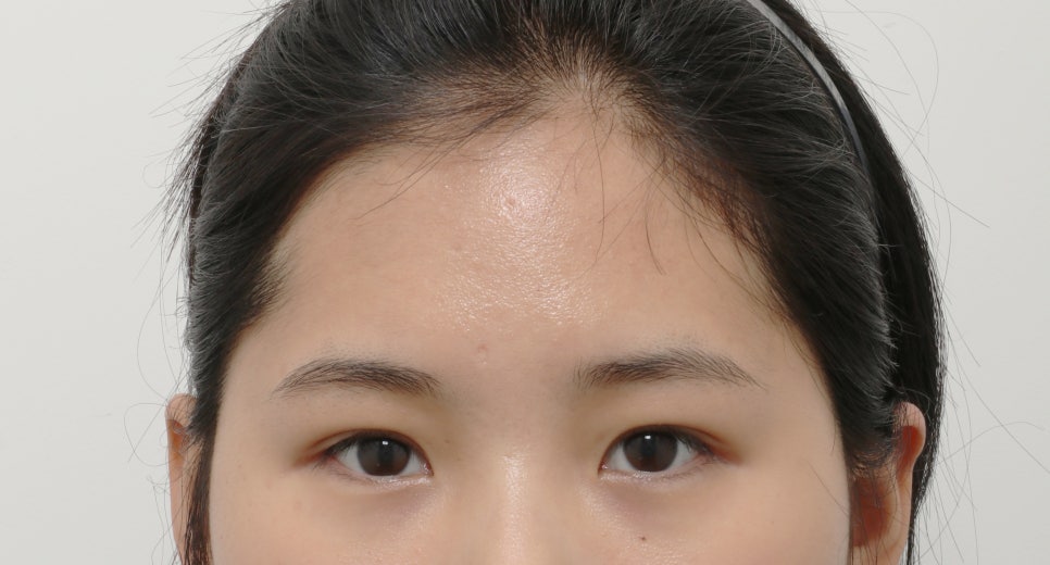Drooping Eyes: How to Address Both Functional Problems and Aesthetic Concerns image 5