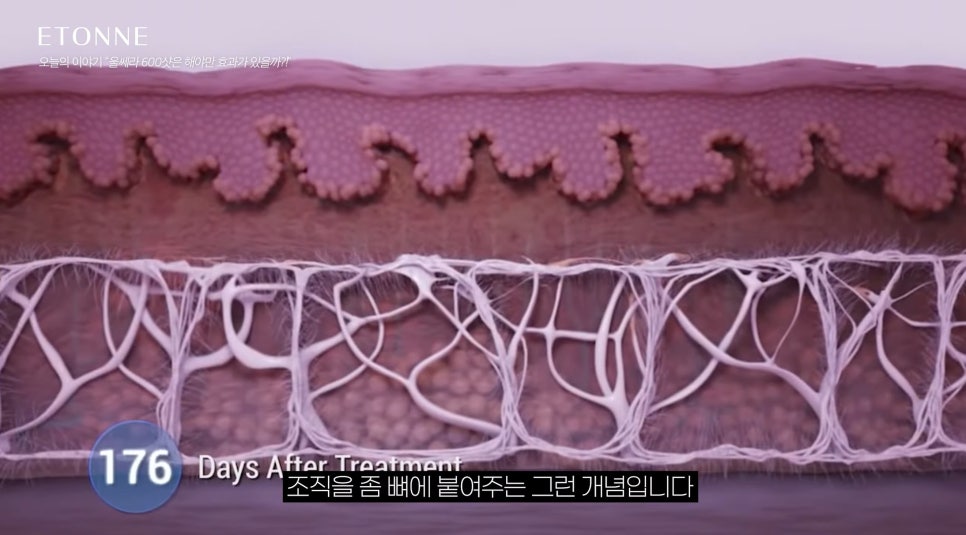 [에톤TV] 울쎄라, 600 샷이 정답은 아닙니다. 나에게 맞는 샷 수와 부작용 줄이는 법! 관련 이미지 2