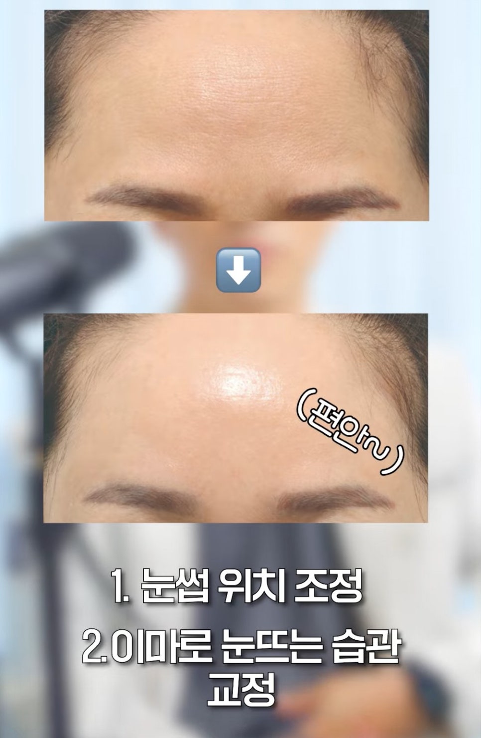 [EtonTV] Don’t get Botox for forehead wrinkles carelessly image 3