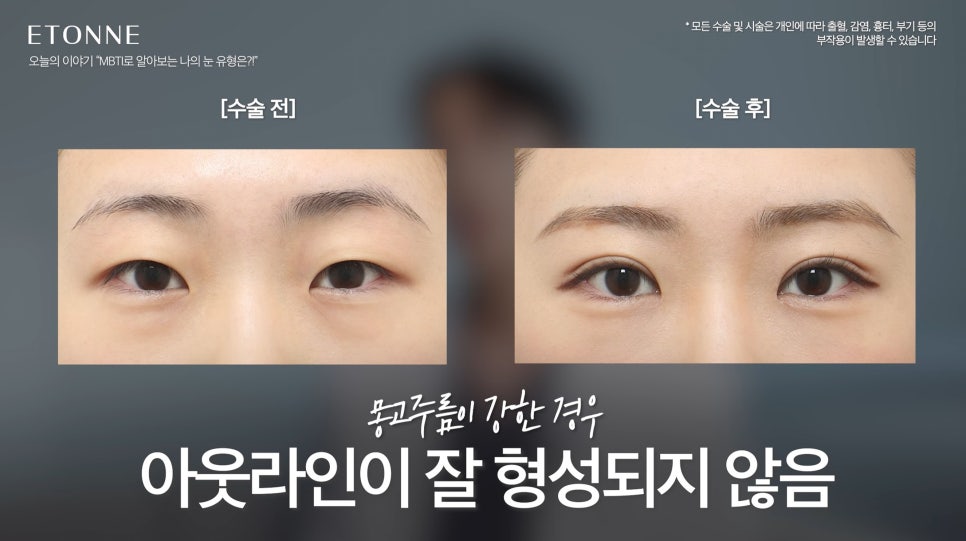 [에톤TV] What Is My Eye Type According to Eye MBTI? image 5