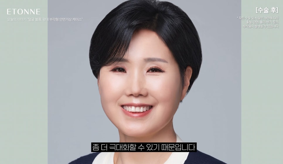 [에톤TV] 얼굴 볼륨, 광대 부각의 경우는 &lsquo;안면거상&rsquo;을 추천합니다 (50대 여성 팔자주름, 마리오네트 라인, 턱라인) 관련 이미지 6